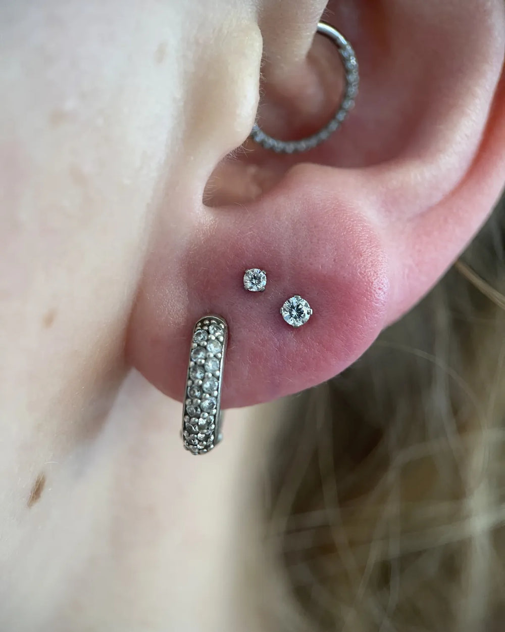 Upper lobe